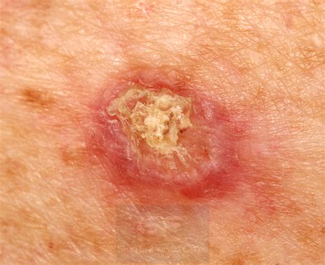 Skin Cancer Photos: What Skin Cancer & Precancerous ...